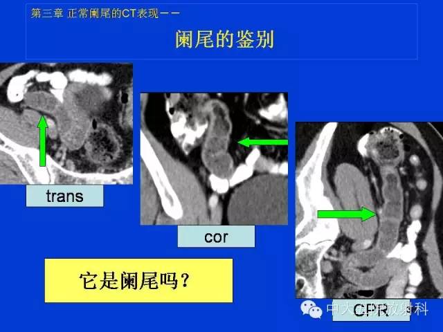 【PPT】正常阑尾和阑尾炎的CT表现