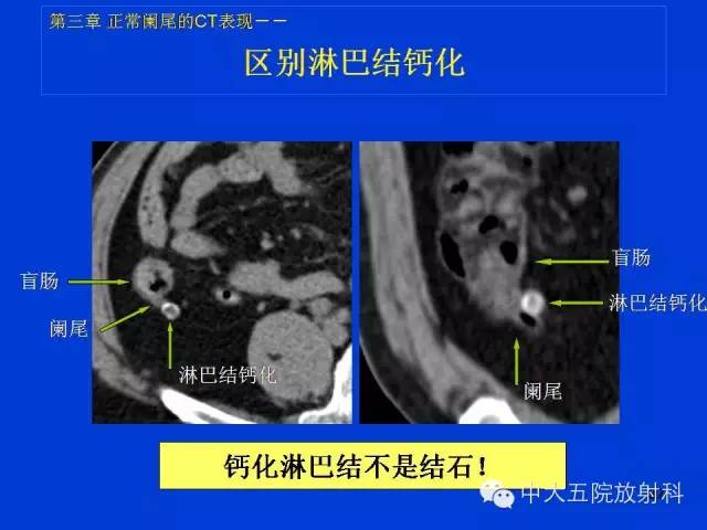 【PPT】正常阑尾和阑尾炎的CT表现