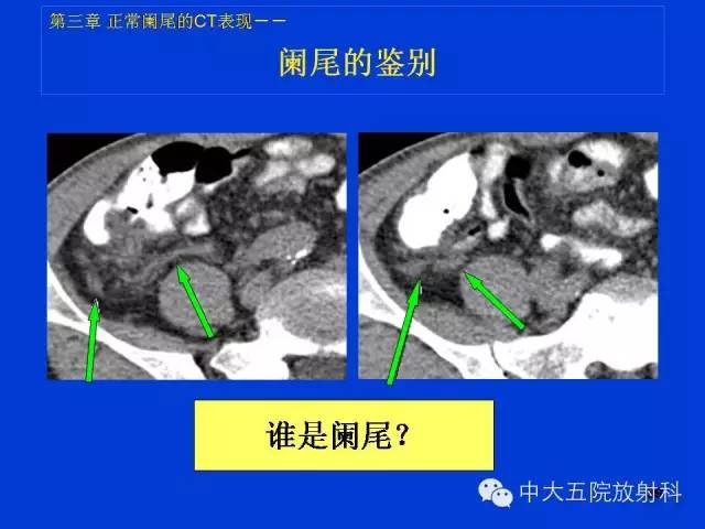 【PPT】正常阑尾和阑尾炎的CT表现