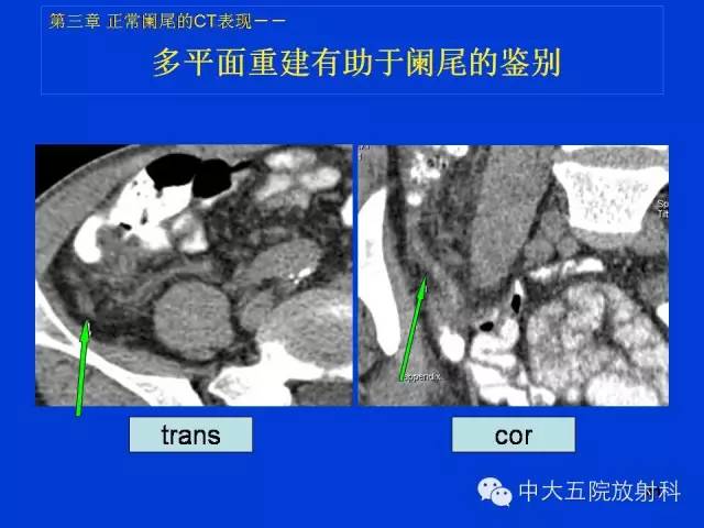 【PPT】正常阑尾和阑尾炎的CT表现