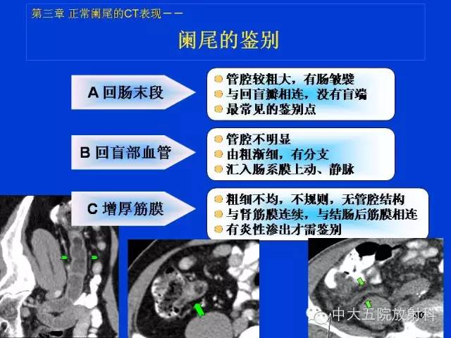 【PPT】正常阑尾和阑尾炎的CT表现