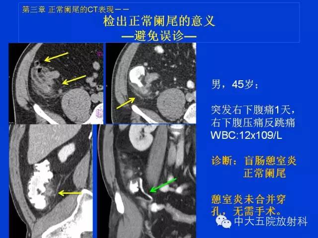 【PPT】正常阑尾和阑尾炎的CT表现