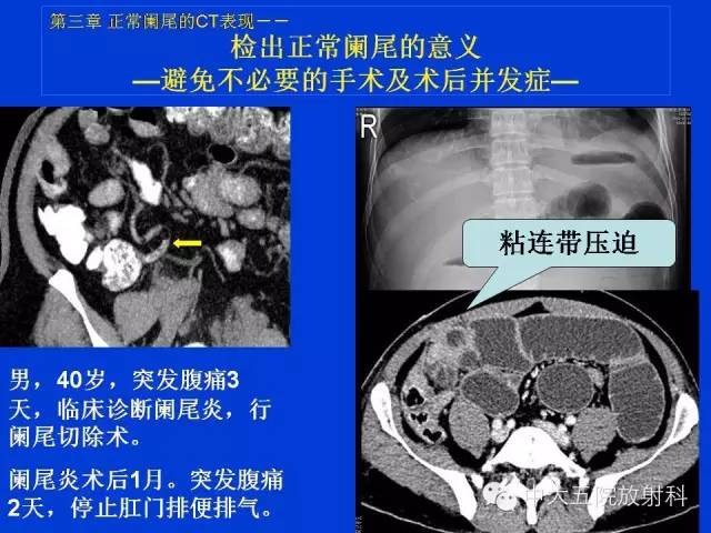 【PPT】正常阑尾和阑尾炎的CT表现
