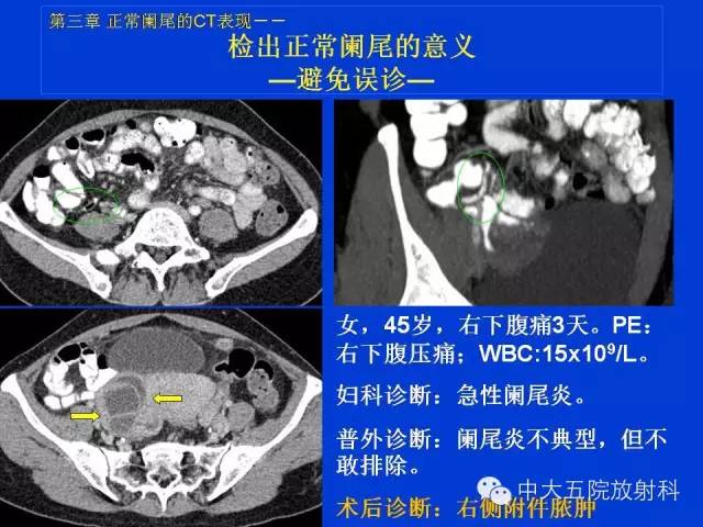 【PPT】正常阑尾和阑尾炎的CT表现