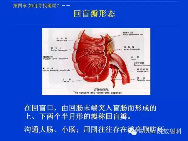 【PPT】正常阑尾和阑尾炎的CT表现