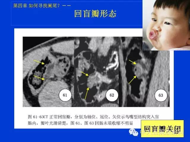 【PPT】正常阑尾和阑尾炎的CT表现