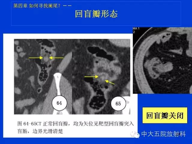 【PPT】正常阑尾和阑尾炎的CT表现