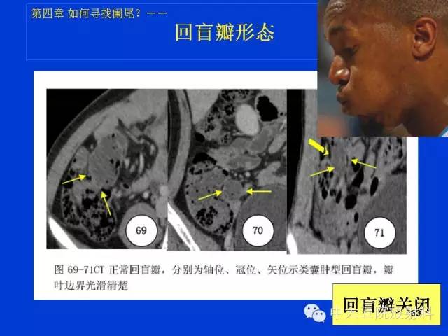 【PPT】正常阑尾和阑尾炎的CT表现