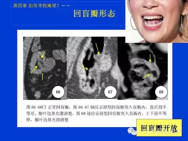 【PPT】正常阑尾和阑尾炎的CT表现