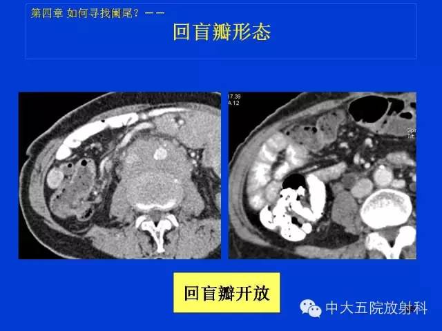 【PPT】正常阑尾和阑尾炎的CT表现