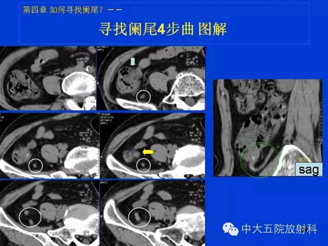 【PPT】正常阑尾和阑尾炎的CT表现