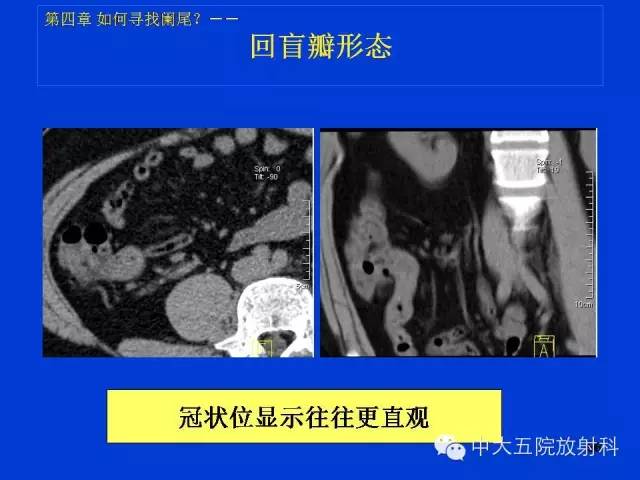 【PPT】正常阑尾和阑尾炎的CT表现
