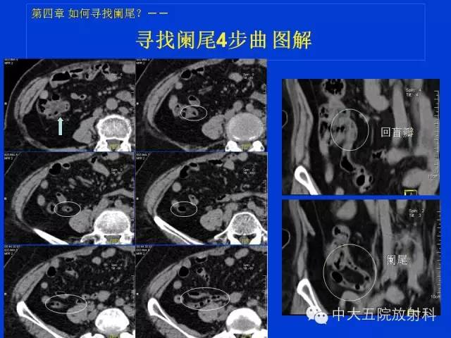 【PPT】正常阑尾和阑尾炎的CT表现