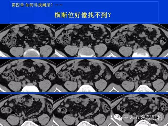 【PPT】正常阑尾和阑尾炎的CT表现
