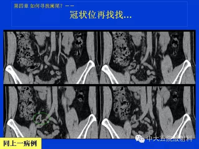【PPT】正常阑尾和阑尾炎的CT表现
