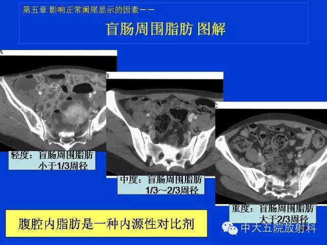 【PPT】正常阑尾和阑尾炎的CT表现
