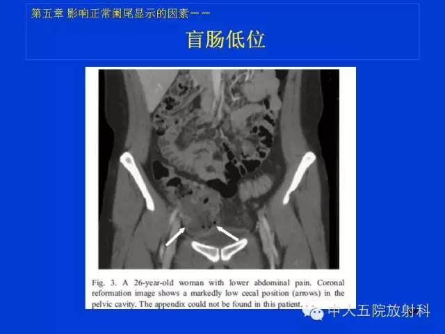 【PPT】正常阑尾和阑尾炎的CT表现
