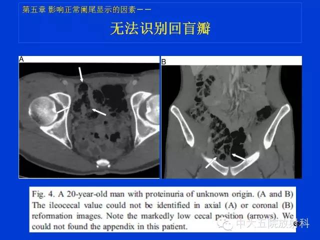 【PPT】正常阑尾和阑尾炎的CT表现