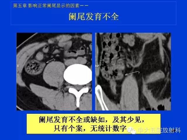 【PPT】正常阑尾和阑尾炎的CT表现