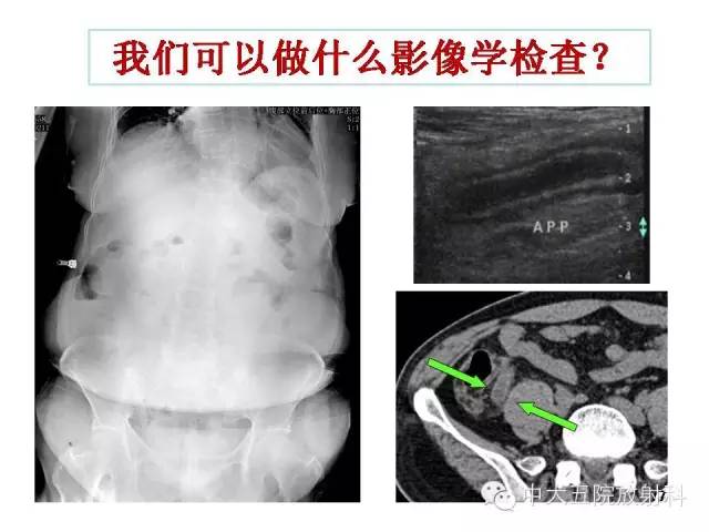 【PPT】正常阑尾和阑尾炎的CT表现