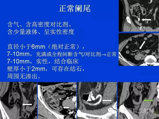 【PPT】正常阑尾和阑尾炎的CT表现