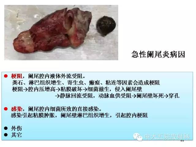 【PPT】正常阑尾和阑尾炎的CT表现