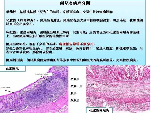 【PPT】正常阑尾和阑尾炎的CT表现