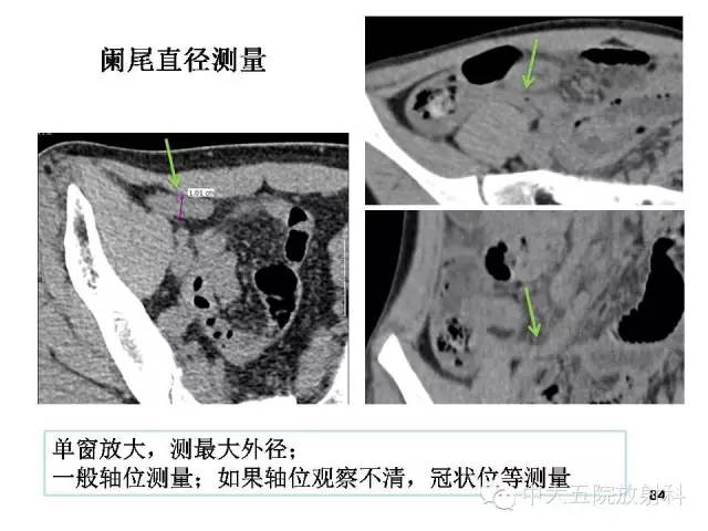 【PPT】正常阑尾和阑尾炎的CT表现