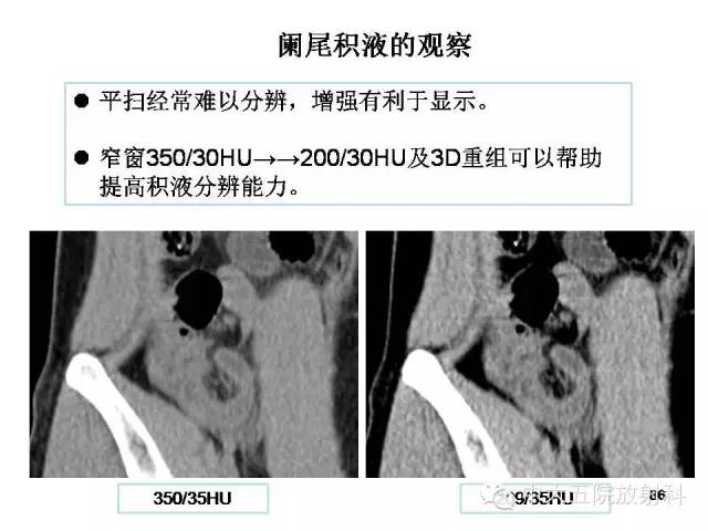 【PPT】正常阑尾和阑尾炎的CT表现