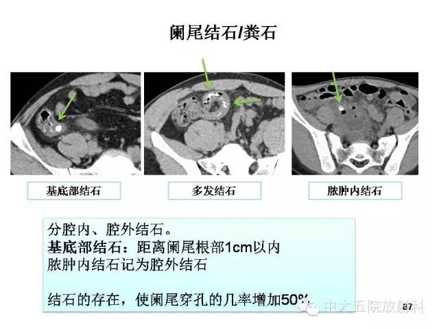【PPT】正常阑尾和阑尾炎的CT表现