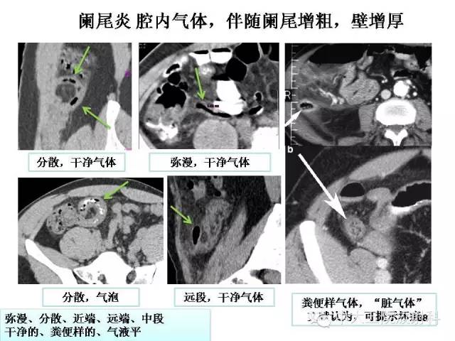 【PPT】正常阑尾和阑尾炎的CT表现