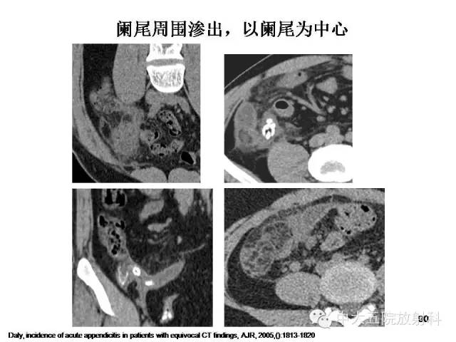 【PPT】正常阑尾和阑尾炎的CT表现