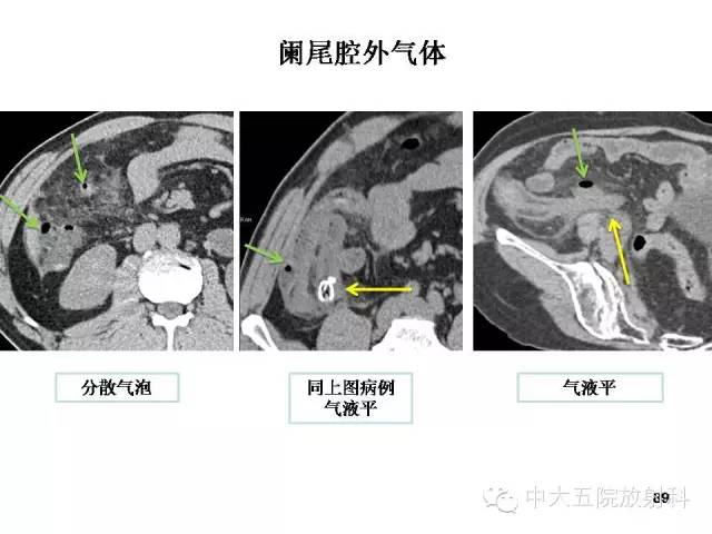 【PPT】正常阑尾和阑尾炎的CT表现