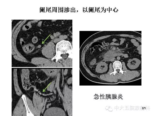 【PPT】正常阑尾和阑尾炎的CT表现