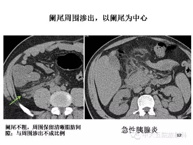 【PPT】正常阑尾和阑尾炎的CT表现
