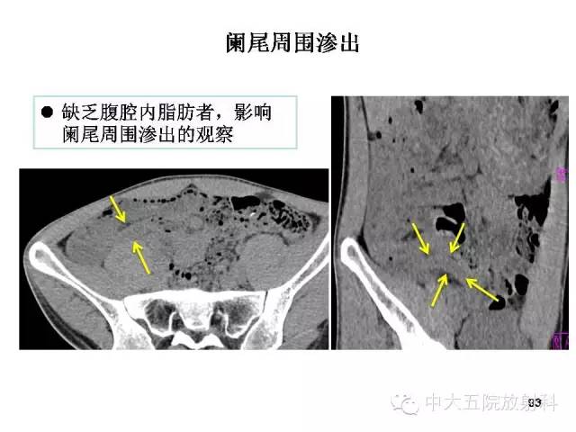【PPT】正常阑尾和阑尾炎的CT表现