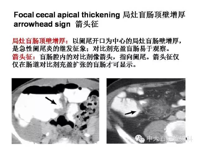 【PPT】正常阑尾和阑尾炎的CT表现