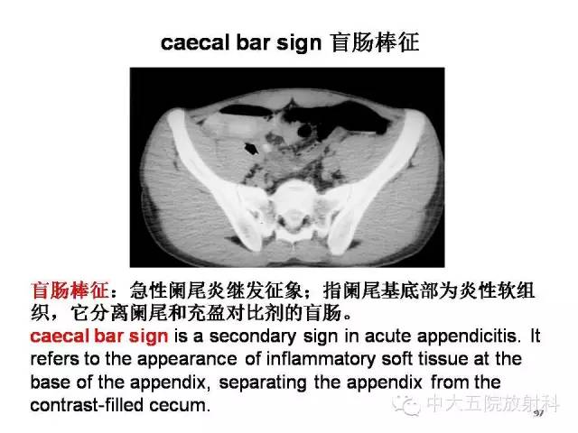 【PPT】正常阑尾和阑尾炎的CT表现