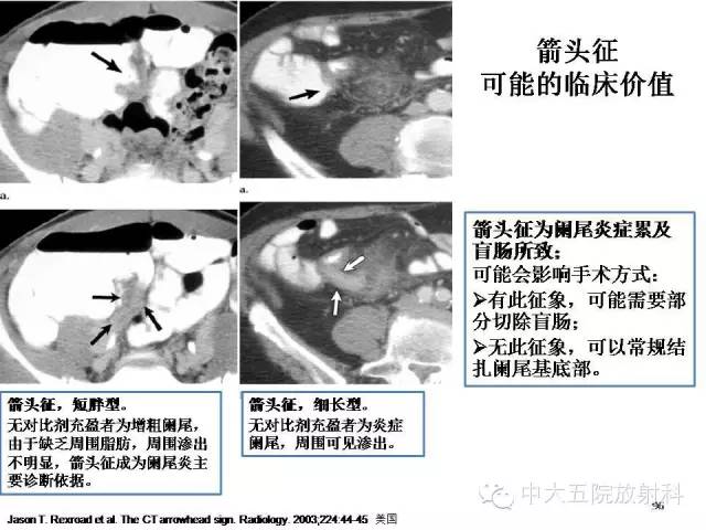 【PPT】正常阑尾和阑尾炎的CT表现