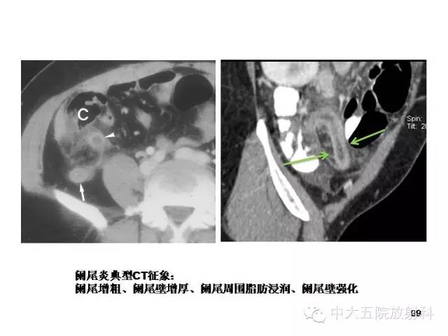 【PPT】正常阑尾和阑尾炎的CT表现