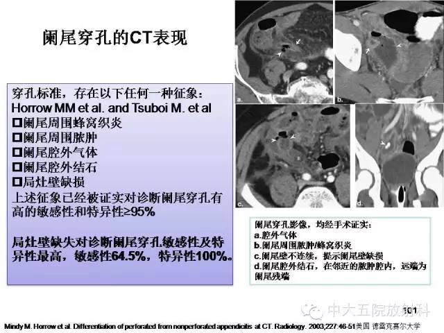 【PPT】正常阑尾和阑尾炎的CT表现