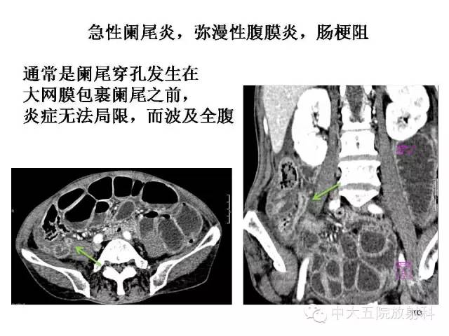 【PPT】正常阑尾和阑尾炎的CT表现