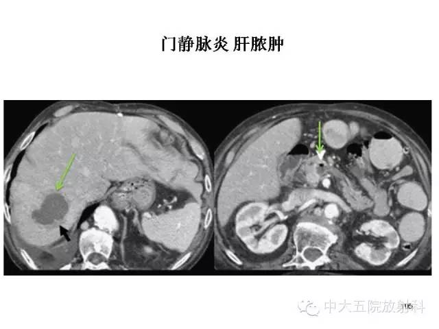 【PPT】正常阑尾和阑尾炎的CT表现