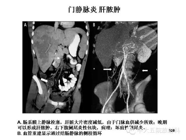 【PPT】正常阑尾和阑尾炎的CT表现