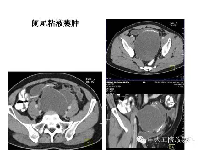 【PPT】正常阑尾和阑尾炎的CT表现