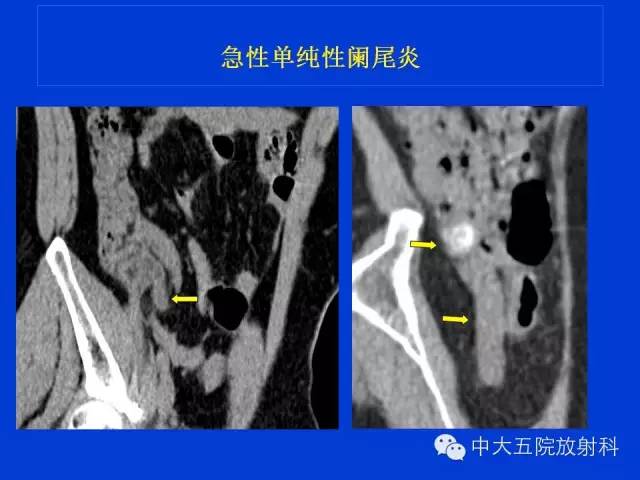 【PPT】正常阑尾和阑尾炎的CT表现