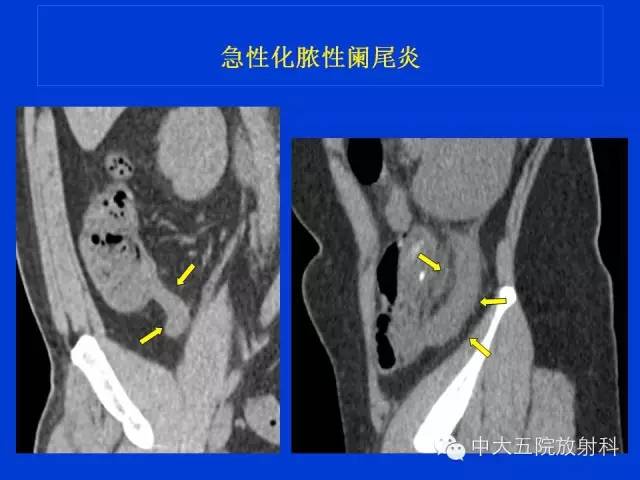 【PPT】正常阑尾和阑尾炎的CT表现