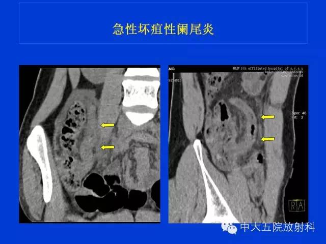 【PPT】正常阑尾和阑尾炎的CT表现