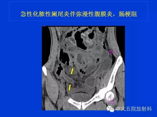 【PPT】正常阑尾和阑尾炎的CT表现