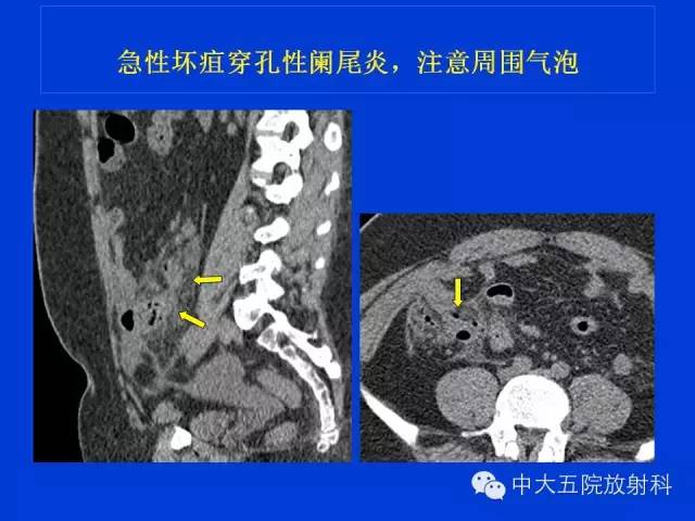 【PPT】正常阑尾和阑尾炎的CT表现